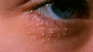 Máte pod očami takéto biele vyrážky? Zistite, čo znamenajú, a ako sa ich zbavíte