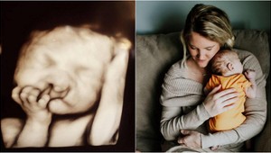 Kvôli extrémnemu rázštepu jej radili potrat: Ako vyzerá chlapček dnes?