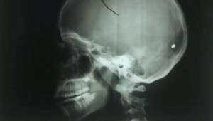 Strelec trafil šiestačku do hlavy, Tvrdošínčania majú strach