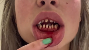 V Turecku jej urobili nové zuby a ľudia sa jej smejú: To, čo máš v ústach?