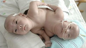 Siamské dvojčatá z Madagaskaru úspešne oddelili