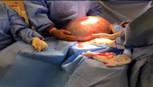 Kde všade v tele môžete mať cystu? Nemusíte o nch ani vedieť