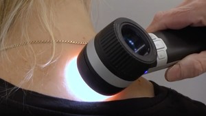 Melanóm sa môže vyskytnúť aj na tých častiach kože, ktoré nie sú vystavované slnku