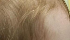 Odborník na popáleniny: Nikdy nevarte s dieťaťom na rukách