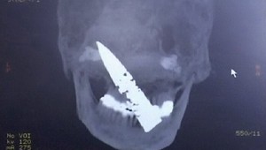 Žil s nožom v hlave a ani o tom nevedel