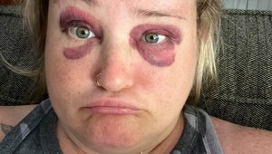 Pár dní pred svadbou dostala loptou do tváre: Takáto z nej bola nevesta!