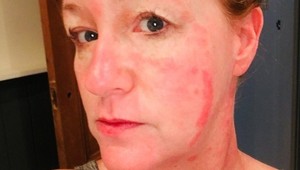 Po dlhých rokoch sa zbavila kožných problémov: Zmenila jednu vec a pleť sa jej uzdravila