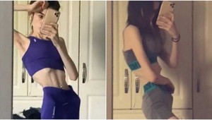 Jedla iba mentolové cukríky, vyhladovala sa na 36 kíl: Ako dopadla vychudnutá tínedžerka?