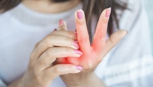 Sklerodermia: Zriedkavá, ale nie neviditeľná