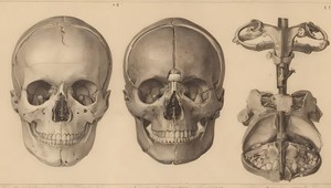 Starovekí Sumeri vŕtali do lebiek ľudí diery