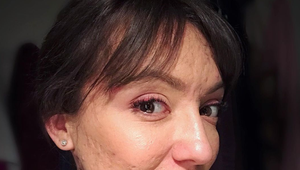 Po celom tele ju trápilo HOROROVÉ akné: Pre vyrážky nemala sex a nemohla nosiť rifle!