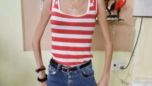 Kvôli extrémnej vychudnutosti ju nechceli zamestnať: Učiteľka vážila iba 33 kíl!