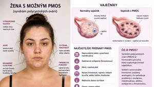 Štúdia zistila, že ženy s hormonálnymi problémami čelia štvornásobne vyššiemu riziku srdcových ochorení
