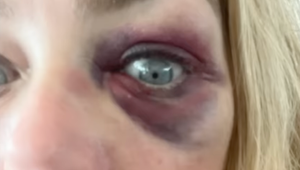 Ďalší škaredý rozvod? Herečka obvinila manžela z násilností, fotka vyzerá desivo!