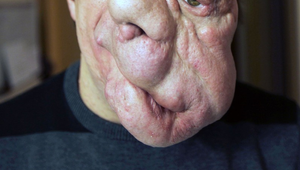 Takýto príbeh lásky u neho nikto nečakal: Znetvorený muž si myslel, že zomrie sám a nemilovaný...