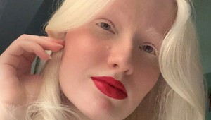 Trpké priznanie nezvyčajnej krásky: V detstve ju kvôli vzhľadu šikanovali, dnes dostáva sexuálne návrhy