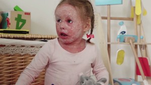 Trojročná Amálka trpí jedinečným kožným ochorením. Je jediná v Česku