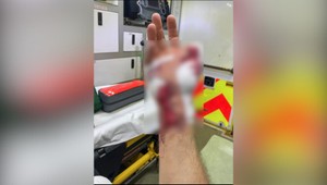 Kuriérka odhryzla mužovi palec. Utrpel vážne zranenia