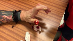 Skvelá správa: Vedci porazili hemofíliu, objavili prelomovú liečbu!