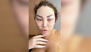 Niekdajší Ken, dnes Barbie ukázala tvár poznačenú operáciou! Priznala celkový počet plastík, šialené číslo!