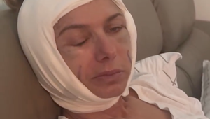 Opuchy, podliatiny, nefungujúce svaly! Česká herečka ukázala desivú tvár a priznala, čo je za tým!