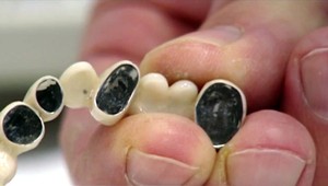 Únia zakázala plomby, ktoré má v ústach trištvrtina Slovákov