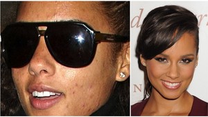 Fľaky či more vyrážok: Ktoré známe tváre ukrývajú pod make-upom akné?