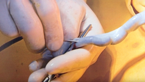 Biznis s pupočníkovou krvou zo Slovenska: Liečba za tisíce eur prebiehala v hotelovej izbe