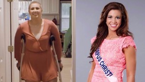 Krásnu volejbalistku a miss pripravila rakovina o nohu, aj napriek tomu sa nevzdáva