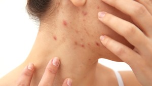 Ste žena a trápi vás akné, nadmerné ochlpenie aj vypadávanie vlasov? Možno máte syndróm polycystických vaječníkov