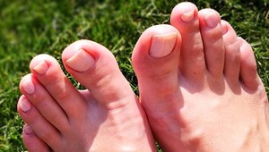 Vysoký cholesterol sa prejaví aj na nohách!  Všímajte si týchto 7 príznakov