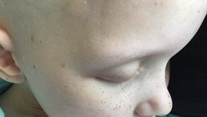 Dievčatko s jedinou mihalnicou zvíťazilo nad rakovinou