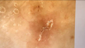 Odborníci varujú: Infekčné ochorenie sa v Taliansku šíri rekordnou rýchlosťou