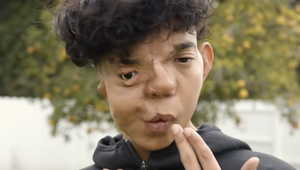 Neuveriteľné: Na operácie už minul milión dolárov, no nehanbí sa za svoju zdeformovanú tvár