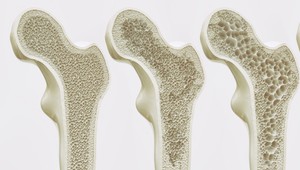 Potrebujete test hustoty kostí? Kedy by ste ho mali podstúpiť?