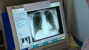 13 ochorení, ktoré ohrozujú vaše pľúca: Čo robiť, ak sa vám ťažko dýcha?