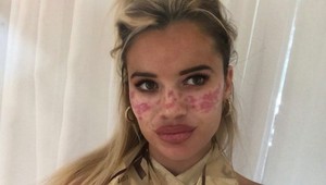 Modelka chcela pehy, po tetovaní prišla extrémna alergická reakcia