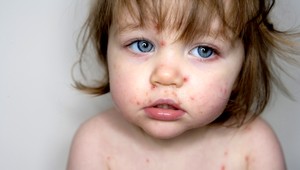 Mali ste pásový opar? Zvyšuje pravdepodobnosť mŕtvice a srdcového infarktu takmer o 30  percent!