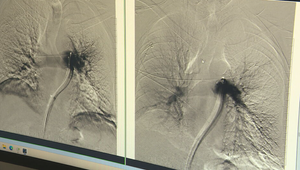Sekundy rozhodujú. Lekári zachraňujú pacientov s pľúcnou embóliou unikátnym zákrokom