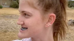 Mladá žena podstúpila operáciu čeluste, výsledok je neuveriteľný! Wau, pozrite sa na ňu!