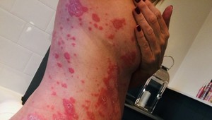 Zdravie čriev ovplyvňuje aj kožu: Vedci tvrdia, že môže súvisieť s psoriázou a ekzémom!