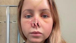 Pes jej odhryzol nos: Lekári jej ho vypestovali na vlastnom ČELE!