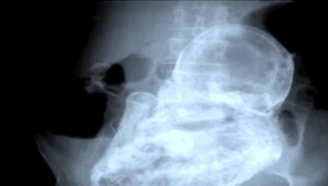 Žena (82) mala v sebe plod, 40-ročný