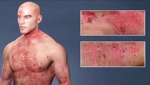 13 každodenných tipov na ľahší život s ekzémom: Čo robiť, aby koža tak nesvrbela?