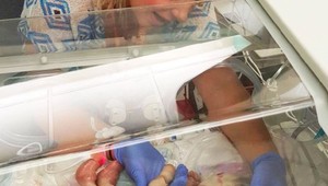 Ako dnes vyzerá dievčatko, ktoré sa narodilo bez kože? Vďaka odlišnosti boduje v modelingu