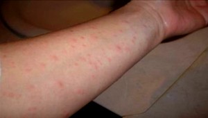 V Bratislavskom kraji pribudol šiesty nakazený osýpkami