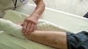 U Slovákov  s cukrovkou rastie počet  amputácií.  Dalo by sa im predísť- preventívnou prehliadkou.