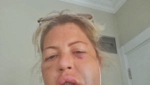 Za krajším chrupom odcestovala do Turecka: Bežný zákrok sa zmenil na horor!