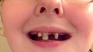 Perlivými nápojmi a fajčením si úplne zničila zuby: Takto ju zmenil nový chrup