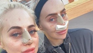 Pripadali si obyčajné, na vylepšenia minuli majland: Dvojičky túžili vyzerať ako bábiky, TOTO je výsledok